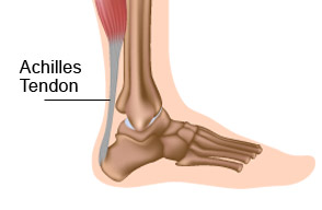 achilles-1 Achilles Tendon Drawing