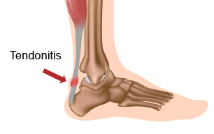 achilles-2 Tendonitis Drawing