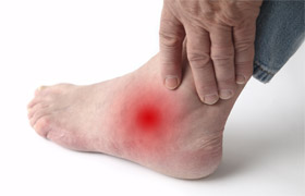 arthritis-1 Photo of foot with red spot showing arthritis pain