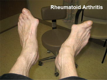 arthritis-3 Photo of feet with Rheumatoid Arthritis