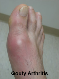 arthritis-4 Photo of foot with Gouty Arthritis