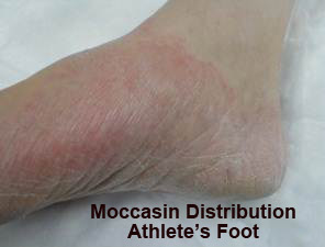 athlete-2 Photo of Moccasin Distribution