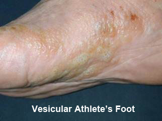 athlete-4 Photo Vesicular Athlete's Foot