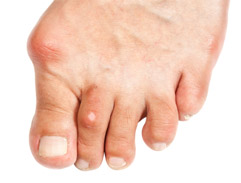 bunions-1 Photo of Bunion on Foot