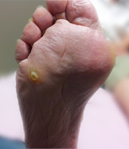 corns-1 Photo of bottom of foot with corn