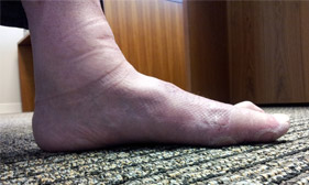 flatfoot-1 Photo of flat foot