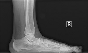 flatfoot-3 X-ray of flat foot