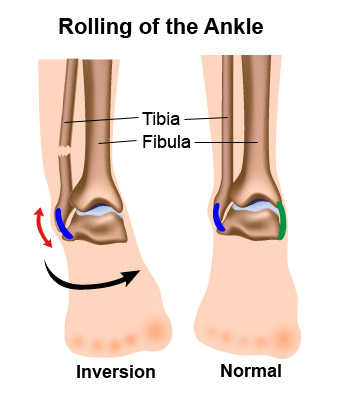 fracture-2 Rolling of the ankle drawing