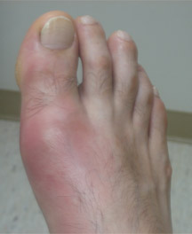 gout-1 Photo of foot with gout