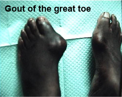 gout-2 Photo of gout of the great toe