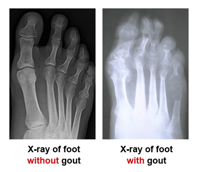 gout-3 X-ray of foot with and without gout