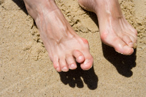 hammertoe-1 Photo of feet with hammertoe