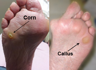 hammertoe-34 Photo of bottom of foot with a corn and a callus