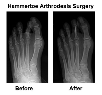 hammertoe-8 X-rays of foot before and after ardrodesis surgery