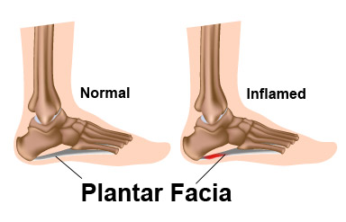 heel-1 Drawing of Plantar Faciitis