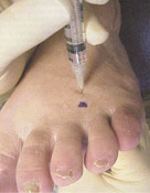neuropathy-2 Photo of injection to the foot