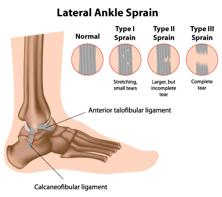 sprain-3 Drawing of ankle sprain types I, II & III