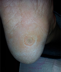 wart-1 Photo of wart on heel