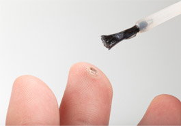 wart-3 Photo of Salicylic acid on wart