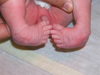 surgery-2 Photo of Congenital foot problem
