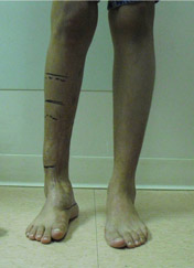 surgery-3 Photo of acquired foot problem
