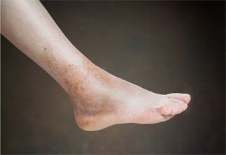 surgery-4 Photo of sprained ankle